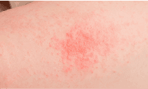 Puffy face, skin irritation, frequent mild colds