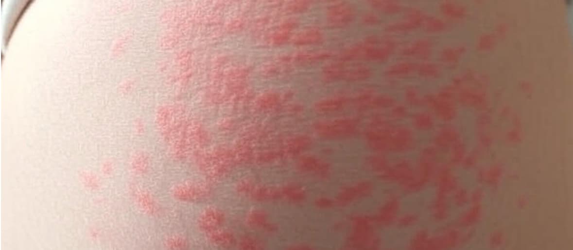 Skin Rashes